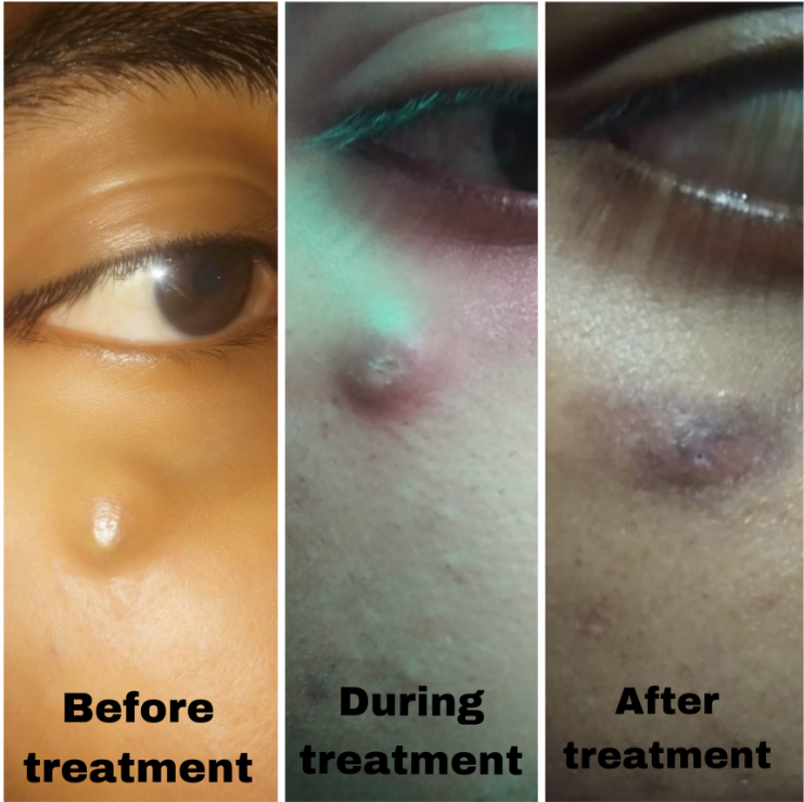 Patient transformation timeline: before, during, after treatment for chronic psoriasis