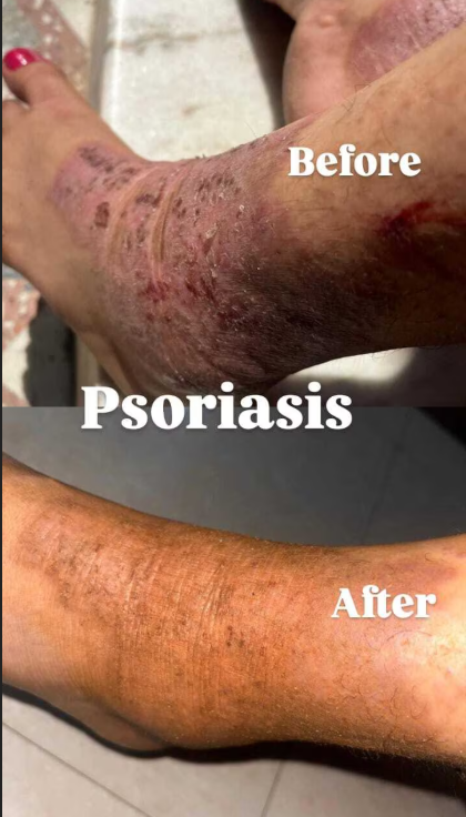 Before and after psoriasis treatment: dramatic skin recovery after classical homeopathy